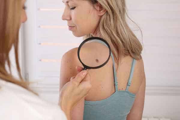 What Are Traditional Skin Lesion Removal Methods Dover?