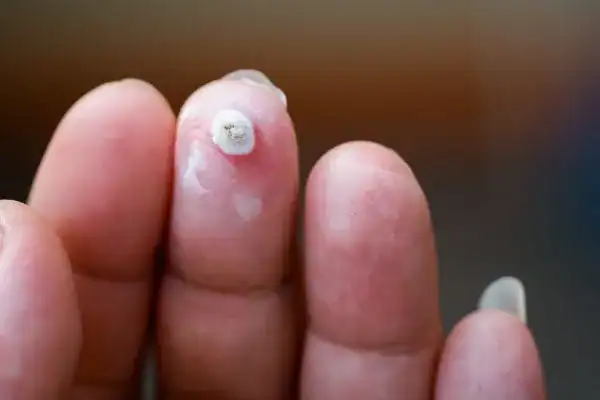 Image of white wart before cryopen treatment Dover