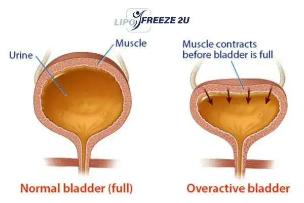 diagram of overactive bladder treatment Dover