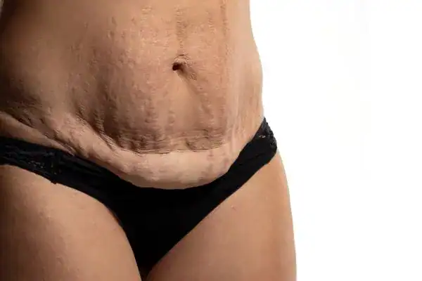 loose skin after weight loss injections Dover