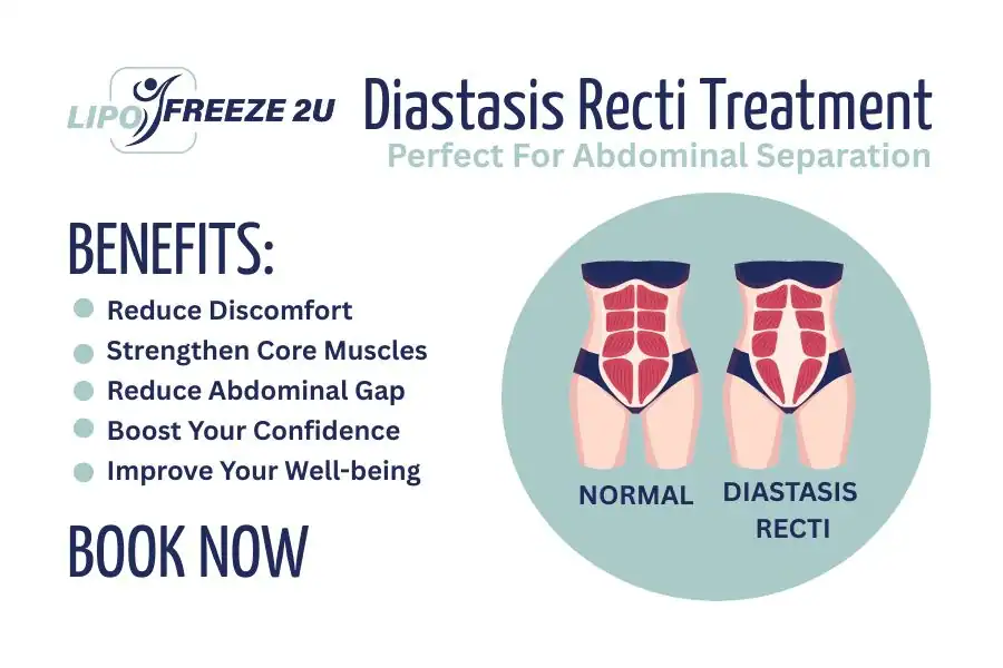 Benefits of body toning treatment Dover for Diastasis recti
