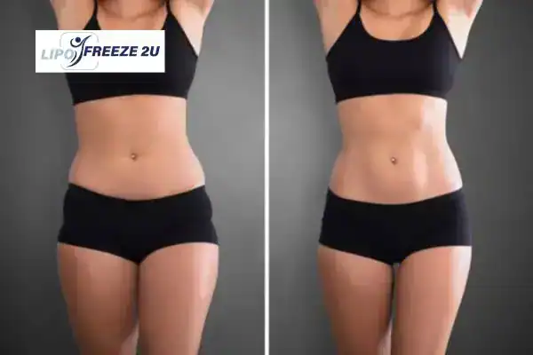 How Can LIPO FREEZE 2U Support Your Post-Pregnancy Body Recovery Dover?