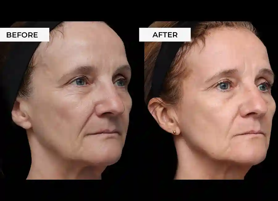 How Many RF Microneedling Sessions Will You Need to See a Difference Dover?