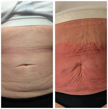 How Does RF Microneedling Improve Crepey, Thin and Uneven Skin Texture Dover?
