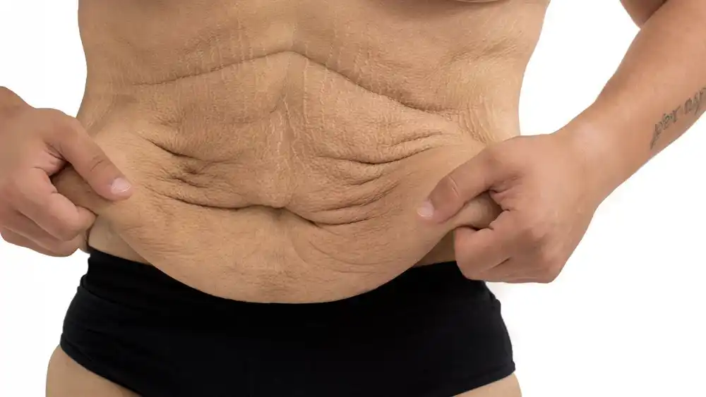 RF Microneedling for Loose Skin: How Can It Help Tighten and Reshape the Skin Dover?